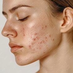 Photo Facial