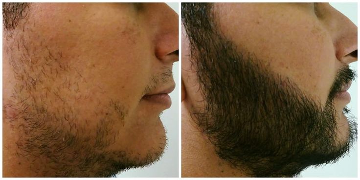 Beard Transplant