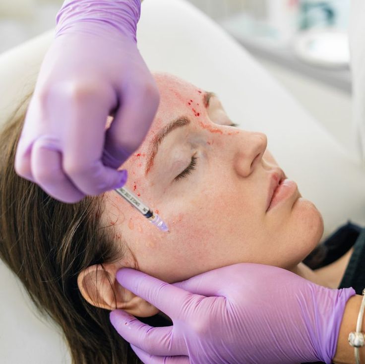 Photo Facial