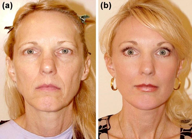 Photo Facial
