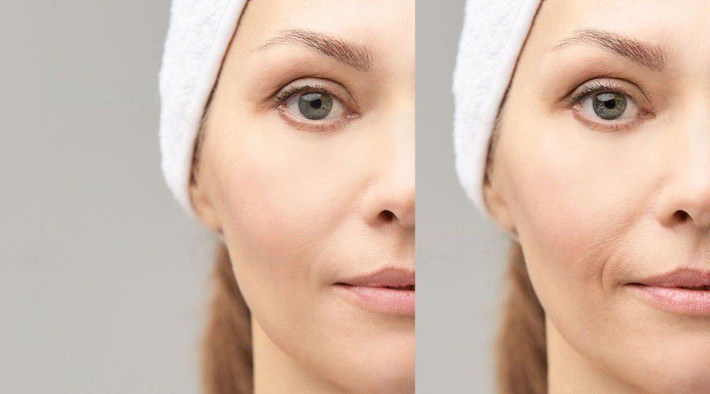 Photo Facial