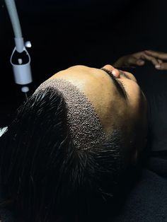 Hair Transplant