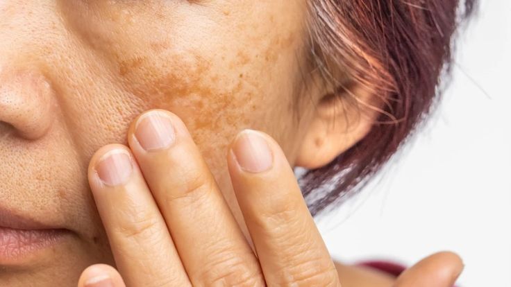 Photo Facial