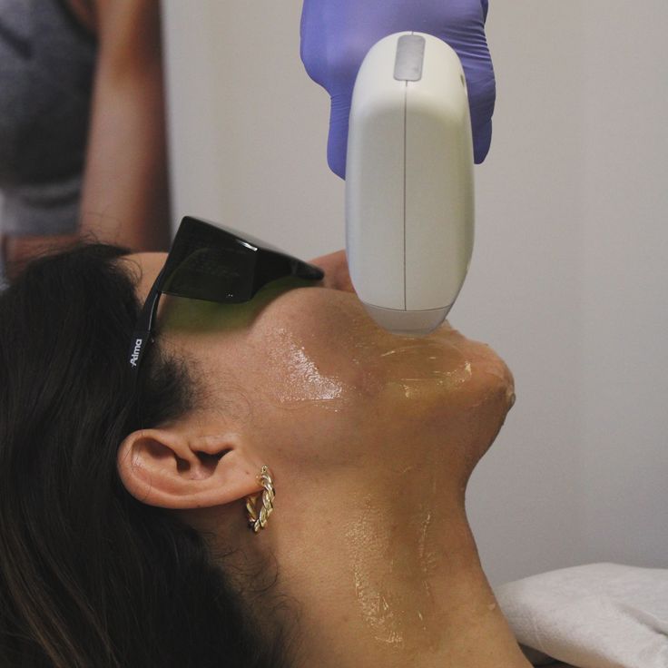 Photo Facial