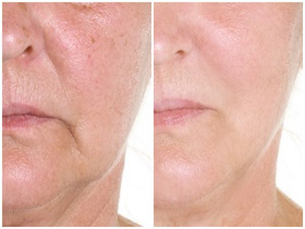Photo Facial