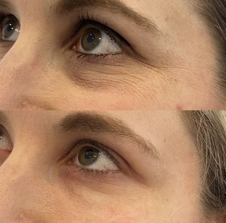Photo Facial