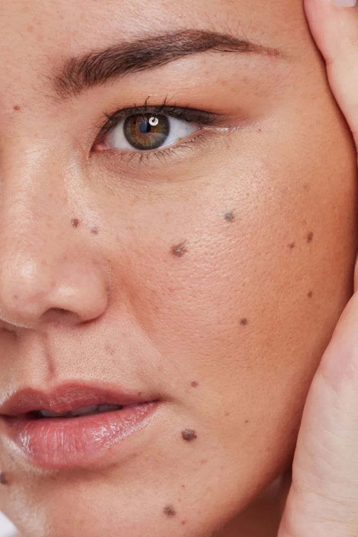 Photo Facial